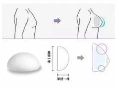 傲诺拉和曼托区别在哪里？什么样的假体能降低隆胸后遗症发生率？