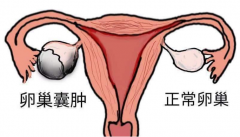 新阳光生殖健康研究中心治多囊卵巢能怀孕吗？